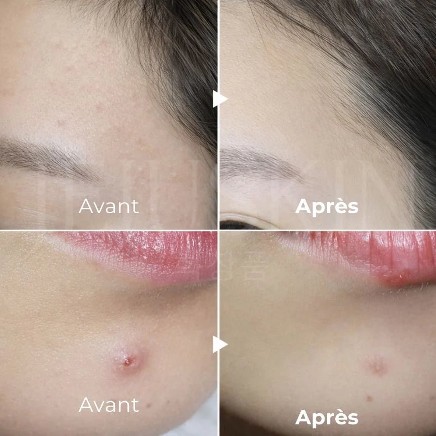 Crème anti - acné Pair W - LION - Mimi's Glow