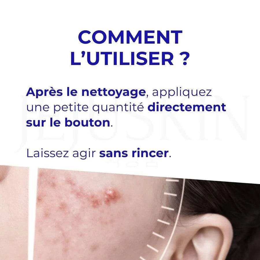 Crème anti - acné Pair W - LION - Mimi's Glow